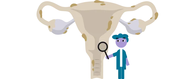 Icono de un útero animado de una paciente con endometriosis.